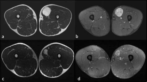 Myxoid Liposarcoma In The Anterior Compartment Of The Left Thigh Shows