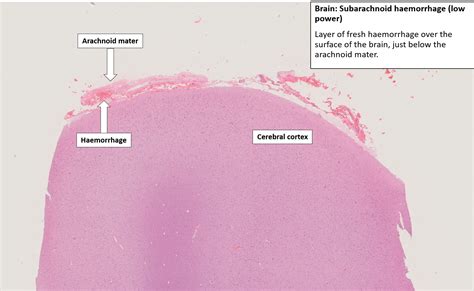 Arachnoid Mater Histology