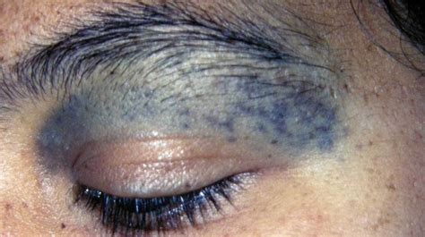 part  melanocytic disorders attaporn