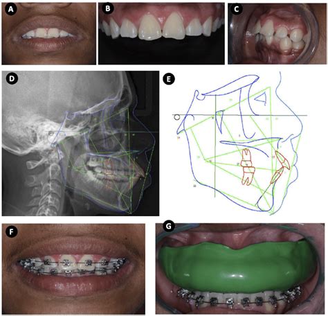 Patient With Increased Positive Overjet Selected For Finite Element