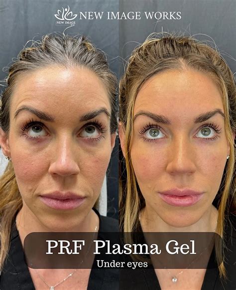 platelet rich plasma prp fibrin prf therapy benefits