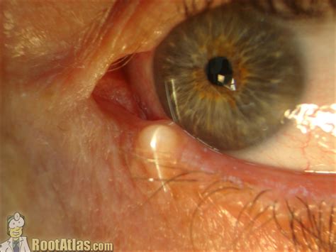 U Nang Biểu Mô Mí Mắt Eyelid Epithelial Inclusion Cyst CỘng ĐỒng