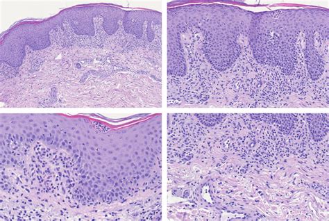 Histopathology Showing A Diffuse Epidermal Acanthosis With