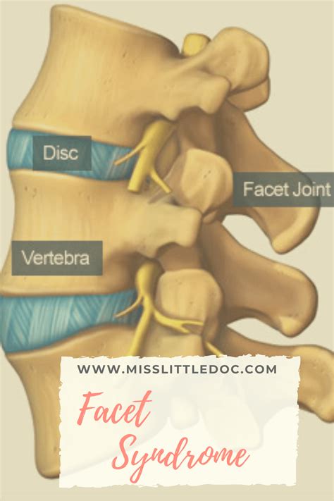 Facet syndrome – Artofit