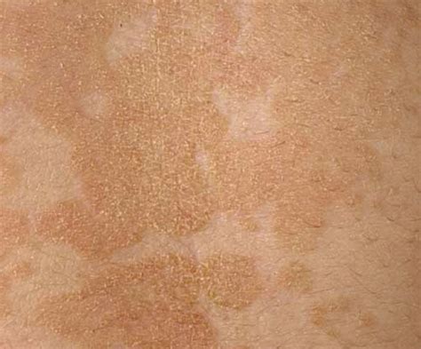 Tinea Versicolor Causes Pictures Photos