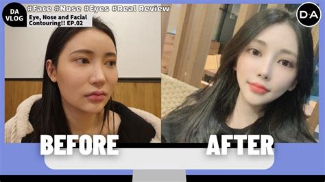 Plastic Surgery Review Episode 2 My Full Face Makeover At Da Plastic