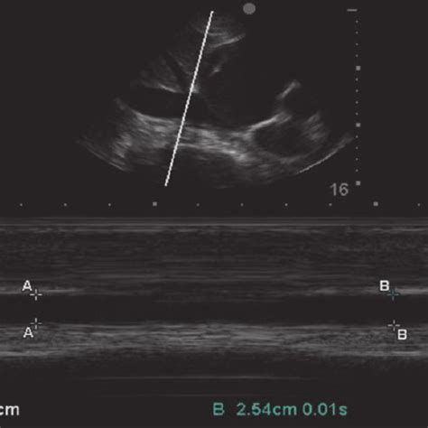 Ultrasound Determination Of Inferior Vena Cava Ivc Diameter Ra Right