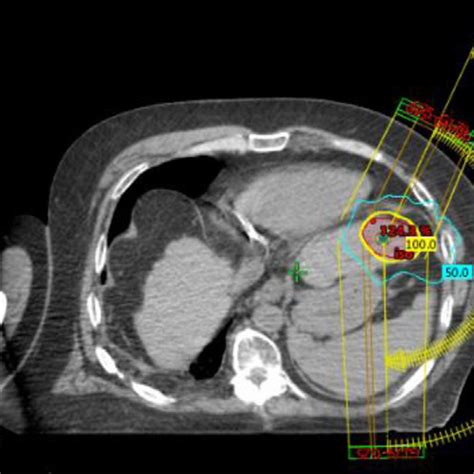 Image Of The Stereotactic Body Radiation Therapy Plan For The Treatment