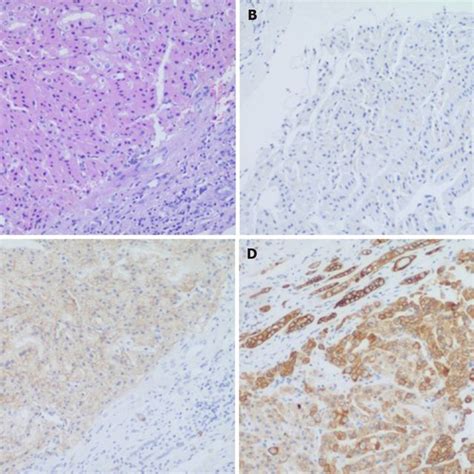 A Year Old Male With Pathologically Proven Clear Cell Renal Cell