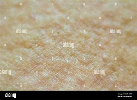 Close Up View Of Cold Urticaria Allergic Rash Symptoms Of Itchy