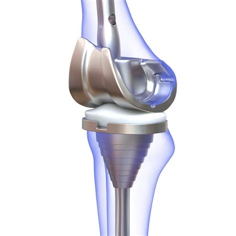 Knee Replacement Implant 3D Model