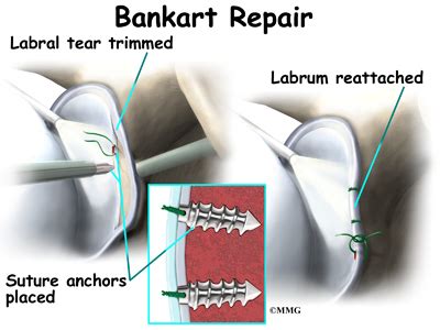 Shoulder Instability - Orthopedic Surgery, Algonquin, IL, Barrington, IL, Elgin, IL, Geneva, IL