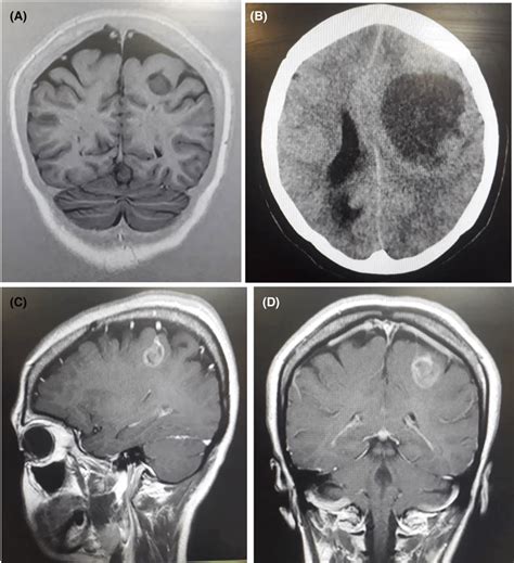 Radiologic Findings Of The Primitive Neuroectodermal Tumor A Download Scientific Diagram