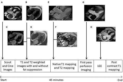 Frontiers Cardiac Myxomas Show Elevated Native T1 T2 Relaxation Time