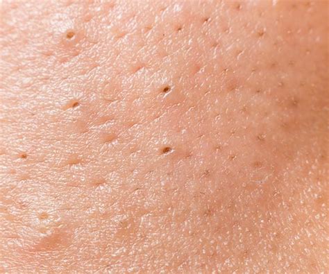 The One Product You Should Stop Using On Blackheads, According To A Dermatologist - SHEfinds