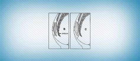 pilonidal sinus dktr tolt dr towliat