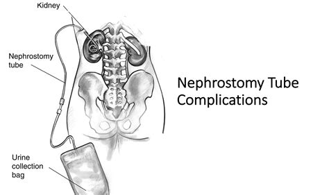 Nephrostomy Tube And Urine Collection Bag Labeled Media 52 Off