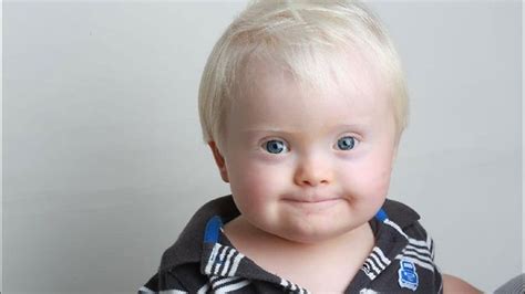 syndrome united states   case reports symptoms
