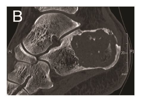 Clinical history: X-ray (a) and CT-scan (b and c) images of calcaneal... | Download Scientific ...