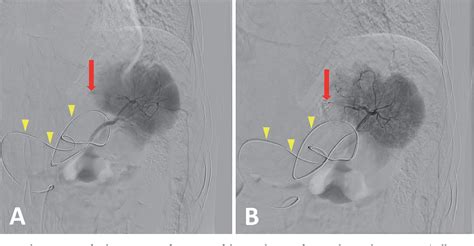 Figure From Transarterial Embolization For Traumatic Splenic Injury