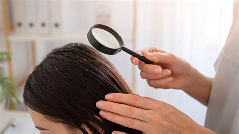 Scalp Psoriasis Vs Dandruff Expert Lists Key Differences You Should Know Onlymyhealth