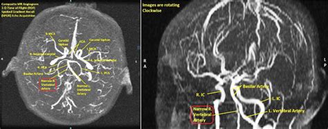 3 D Time Of Flight Spoiled Gradient Recall Tof Spgr Echo Acquisition