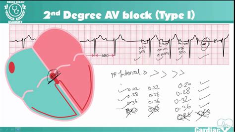 2nd Degree Heart Block Type II