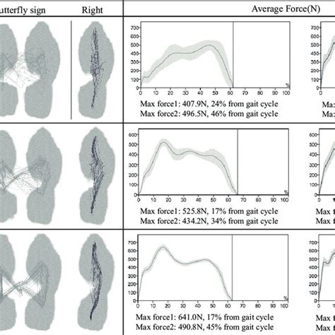 Butterfly Sign And Change In Floor Reaction Force Download Scientific