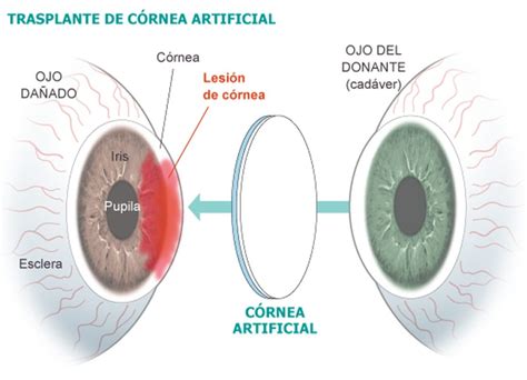 Transplante de Cornea Web Clínica Oftalmológica de la Calzada