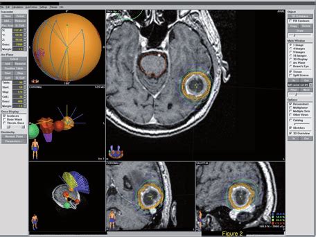 Treatment Plan For LINAC Stereotactic Radiosurgery Of The Left Temporal