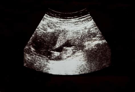 25 Weeks Pregnant Ultrasound