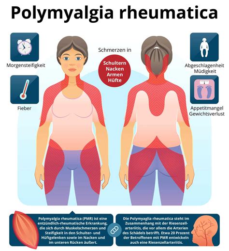 Polymyalgia Rheumatica Ursachen Symptome Behandlung