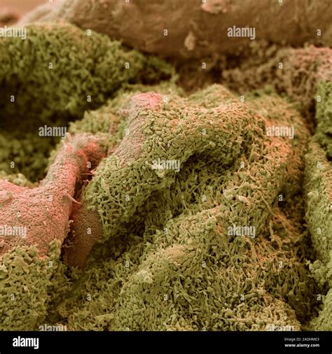 Nasal Polyp Surface Coloured Scanning Electron Micrograph Sem Of The