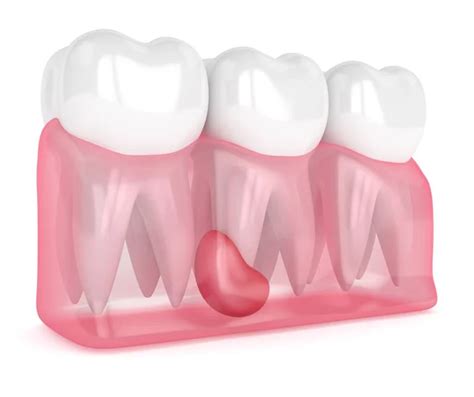 Render Translucent Gums Cracked Tooth Root White Background Different