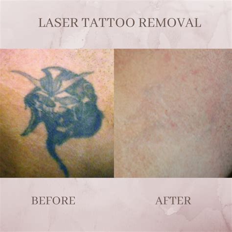 Tattoo Removal - Eluma - Laser & Aesthetics