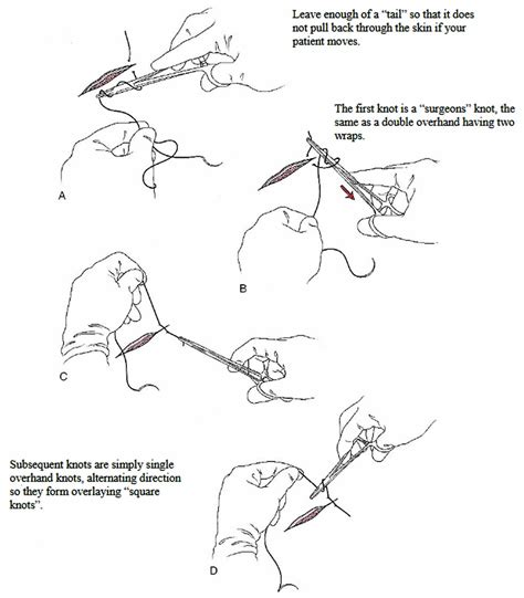 Surgical suture, types of sutures, sizes, how to suture & suture ...