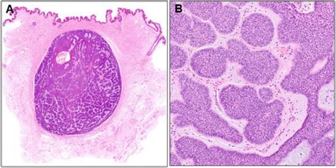 Recurrence Or De Novo Intradermal Basal Cell Carcinoma Of The Scrotum