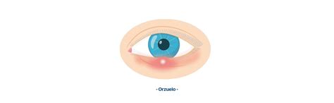 ¿por Qué Salen Bolitas De Grasa En Los Ojos Descubre Las Causas Y