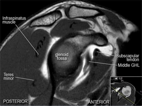 MRI Musculo-Skeletal Section: MRI anatomy of the shoulder (sagittal view).