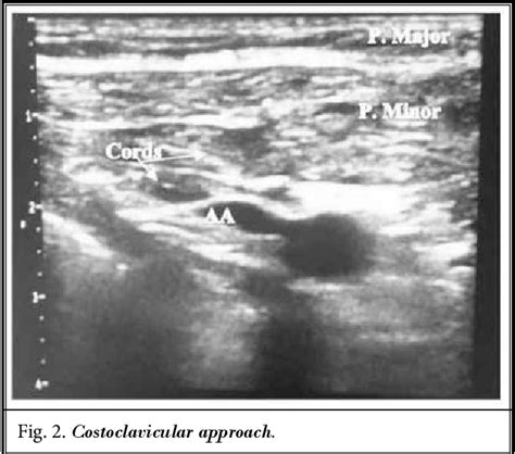 Figure From Ultrasound Guided Retroclavicular Approach Versus