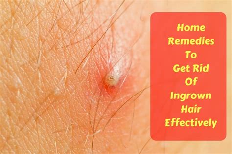 23 Home Remedies To Get Rid Of Ingrown Hair Effectively Wellness Guide