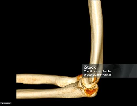 A 3d Ct Scan Of The Elbow Joint Showing Normal Bone Structure And