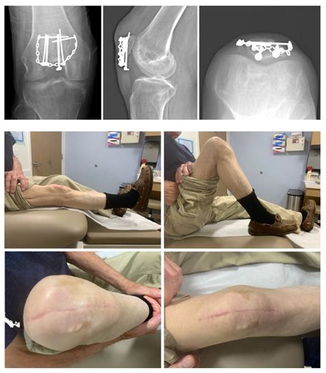 Treatment of a comminuted patella fracture with a patella rim plate- a