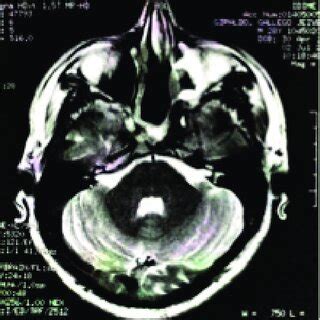 Corte Axial De Tomografia Computadorizada Janela Ssea Evidencia