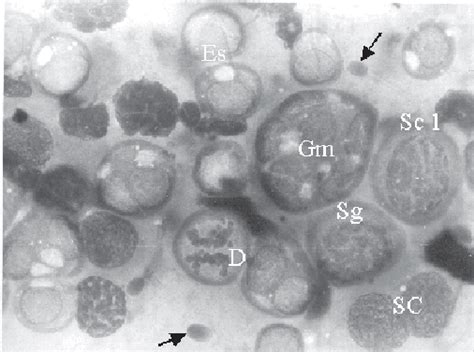 Figure 2 From Evaluation Testicular Fine Needle Aspiration Cytology And