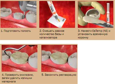 Estemp ne 10г 2шпр цемент стоматологический временный spident