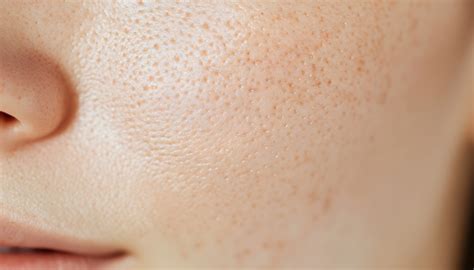 treatment  large pores pores  face solutions