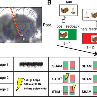 A, Intraoperative targeting of SN. During DBS surgery, a microelectrode ...