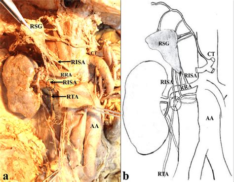 The Variation In Branching Pattern Of Inferior Suprarenal Artery On The