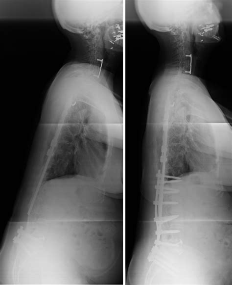 Flatback Syndrome The Body Loses The Natural Curve In Their Lower Back